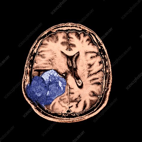 MR of Malignant Brain Tumor, 3 of 3   Stock Image   C004 ...