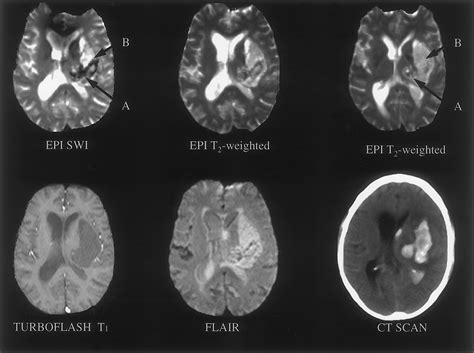 MRI Features of Intracerebral Hemorrhage Within 2 Hours ...