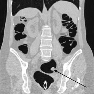 MRI sagittal section of the rectum adenocarcinoma. White ...