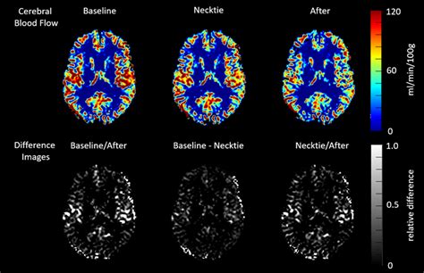 MRI scans show neckties cut blood flow to brain