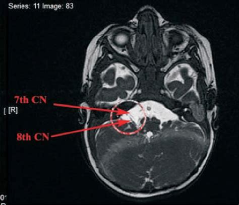 MRI showing hypoplasia of multiple cranial nerves on the ...