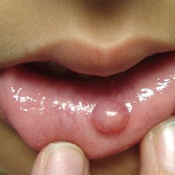 Mucocele of the Lower Lip * OTOLARYNGOLOGY HOUSTON