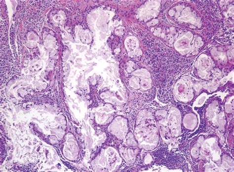 Mucoepidermoid Carcinoma of the Parotid Gland: The Mayo Clinic ...
