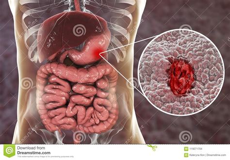 Mucosa Del Estómago Con La úlcera Péptica Stock de ...