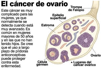 MUJER POSTMENOPAUSICA: CANCER DE OVARIO