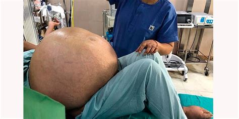 Mulher de 52 anos retira do ovário tumor de 50 kg, maior ...