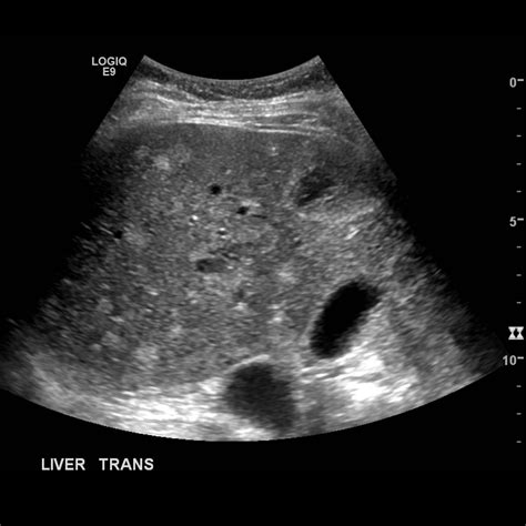 Multiple biliary hamartomas | Image | Radiopaedia.org