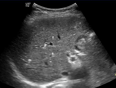 Multiple biliary hamartomas | Image | Radiopaedia.org