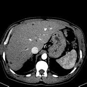 Multiple biliary hamartomas | Radiology Reference Article | Radiopaedia.org