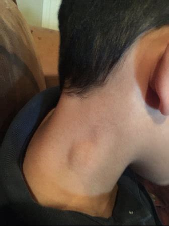 Multiple lumps in neck | BabyCenter