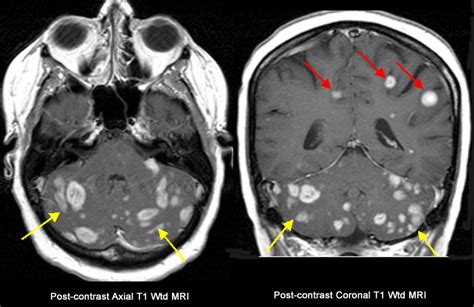 Multiple Metastasis To The Brain From Breast Primary
