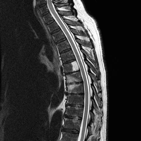 Multiple myeloma   spine | Image | Radiopaedia.org