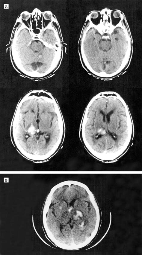 Multiple Simultaneous Intracerebral Hemorrhages: Clinical ...