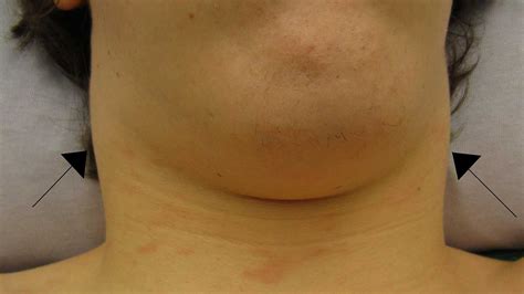 Neck Lump: Pictures, Causes, Associated Symptoms, and More