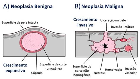 Neoplasia Benigna   sintomas, causas, tratamento, tumor, é ...