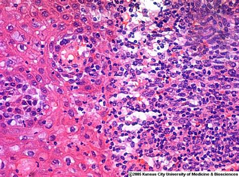 NEOPLASIA I: WHAT IS CANCER?