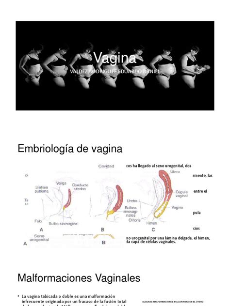 Neoplasia Intraepitelias Vaginal y Carcinoma Escamoso ...
