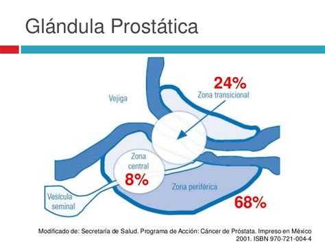 Neoplasia Maligna De Prostata   SEONegativo.com