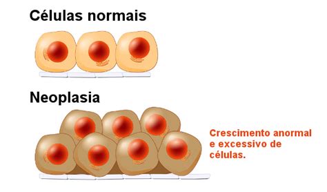 Neoplasia: o que é, tipos, exemplos, tratamentos   Brasil ...