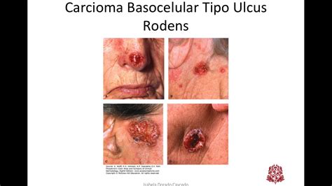 Neoplasias Malignas Carcinoma Basocelular   YouTube