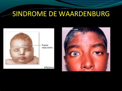 Neurofibromatosis o enfermedad de von recklinghausen