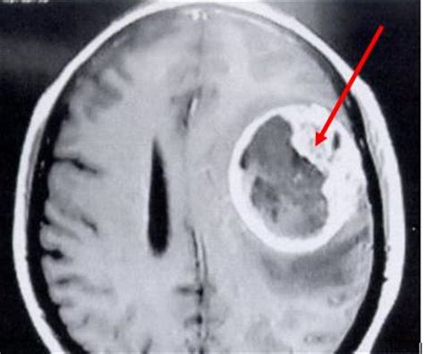 Neurologia | Neurocirugia.Cefalea, jaqueca  Tumor cerebral ...