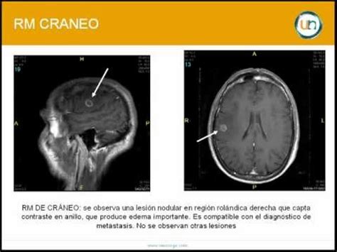 Neurorgs.net   ¿Cómo abordar una metástasis cerebral ...