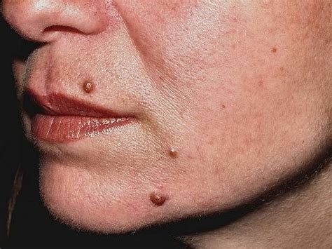 Nevus, verrugas, lesiones dermicas benignas   Tratamientos ...