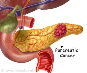 New Combination Blood Test for Pancreatic Cancer ...