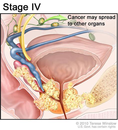 New Subtype of Treatment Resistant Prostate Cancer ...