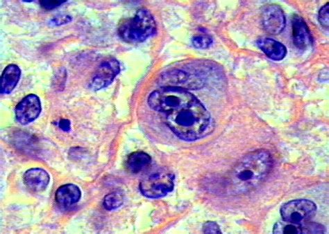 Next Biotechnology News | eBio World: Hodgkin’s lymphoma