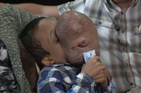 Niño cubano con un tumor en la cara: “yo sí puedo seguir ...
