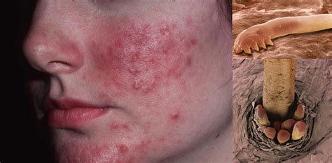 NO es acné, es una enfermedad provocada por múltiples PARÁSITOS en la cara.