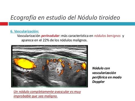 Nódulo tiroideo clasificación Ti rad
