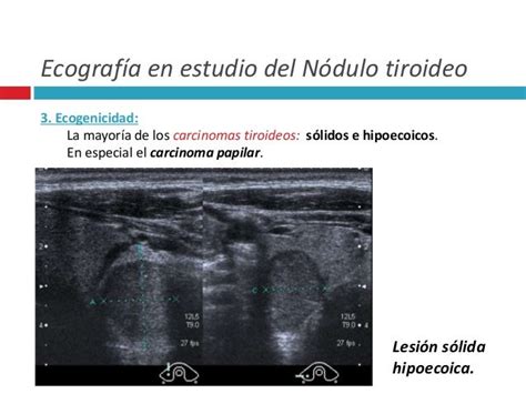 Nódulo tiroideo clasificación Ti rad