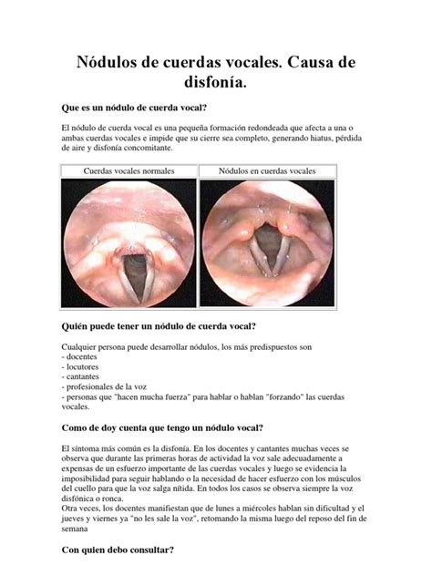 Nódulos de cuerdas vocales | Ciencias de la Salud | Bienestar