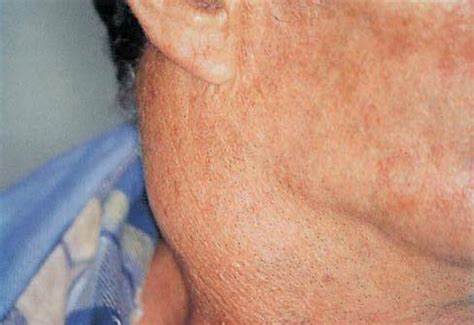 Nódulos linfáticos en el cuello: causas, diagnóstico, tratamiento