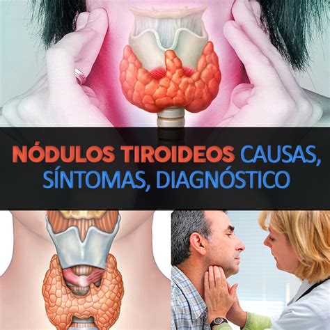 Nódulos tiroideos: causas, síntomas, diagnóstico y ...