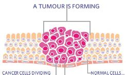 Non Cancerous Tumor Treatment In India | Benign Cancer Surgery