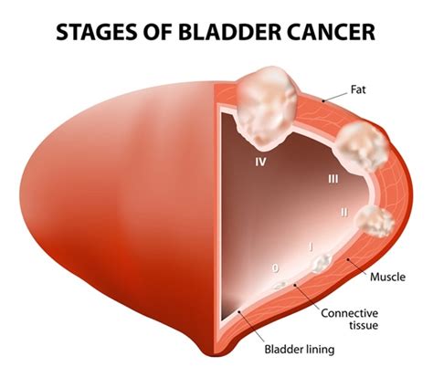 Non Invasive Diagnostic Strategies for Bladder Cancer