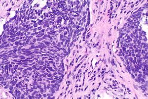 Non small cell lung carcinoma   Libre Pathology