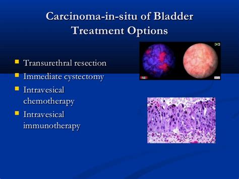 non surgical therapies of bladder cancer