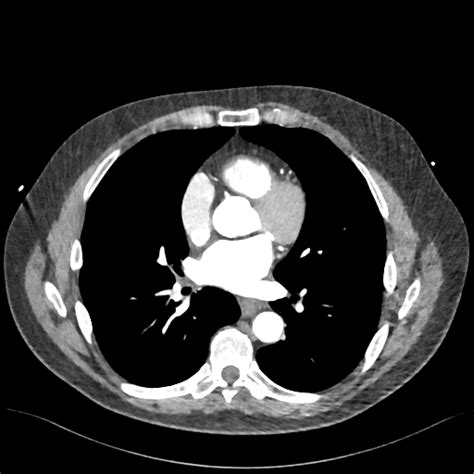 Normal CTA thorax  ECG gated  | Image | Radiopaedia.org