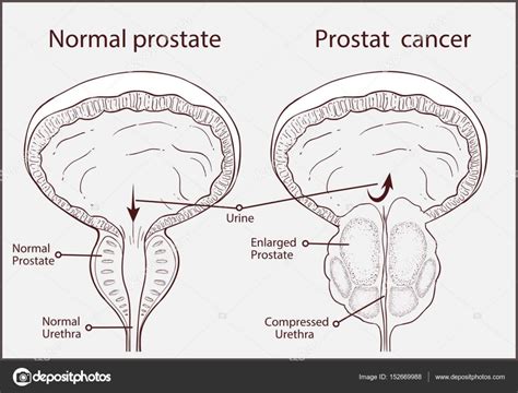 normal prostate and acute prostatitis. Medical illustration — Stock ...