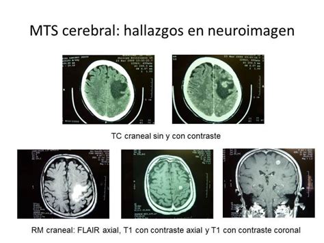 Nuevo artículo sobre Metástasis Cerebrales | NeuroWikia