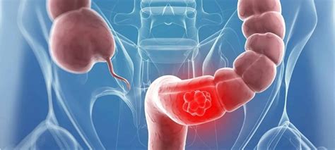 Nuevo tratamiento para cáncer de colon podría eliminarlo completamente