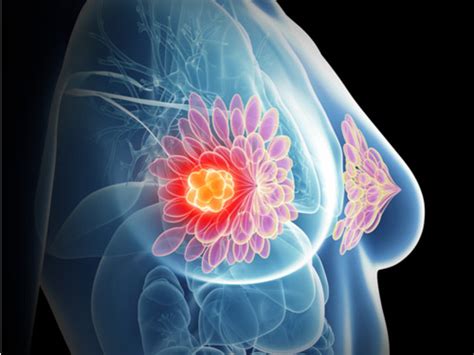 Nuevo tratamiento para cáncer de mama metastásico permite ...