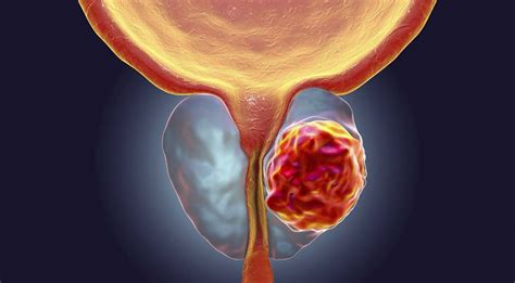 O câncer de próstata pode voltar após a cirurgia? Dr. Leonardo Ortigara