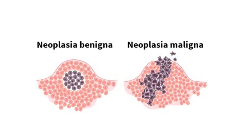 O que é neoplasia   Como é formada, diferenças entre benigna e maligna
