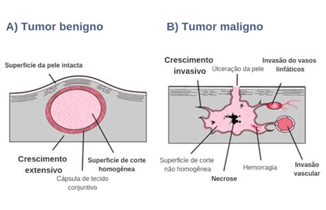 O que é um tumor benigno?   Educar Saúde